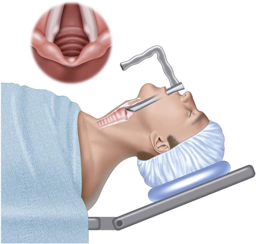 Image 5. Laryngoscopie en suspension, permettant l’accès aux cordes vocales pour une injection intra-cordale (médialisation), sous anesthésie générale.
