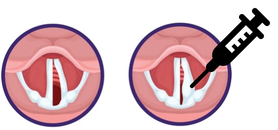 Image 6. Médialisation d’une corde vocale paralysée (paralysie unilatérale).