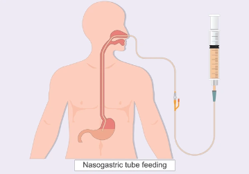 Image 7. Sonde nasogastrique : la sonde passe par le nez pour aller dans l’estomac.