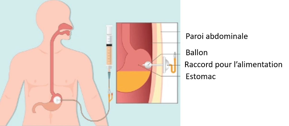 Image 8. Gastrostomie : la sonde est placée directement dans l’estomac à travers la peau par le ventre.