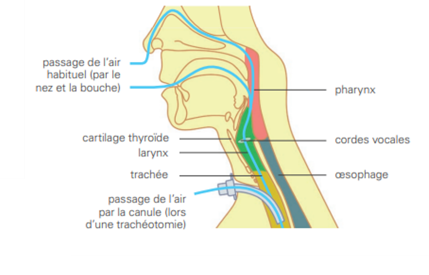 Image 9. Trachéotomie : mise en place d’une canule dans la trachée, entre la pomme d’Adam (cartilage thyroïdien) et la base du cou.