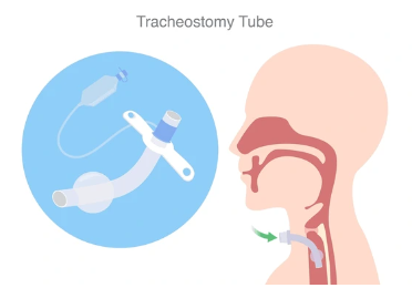 Image 10. Canule à ballonnet pour protection des voies aériennes.